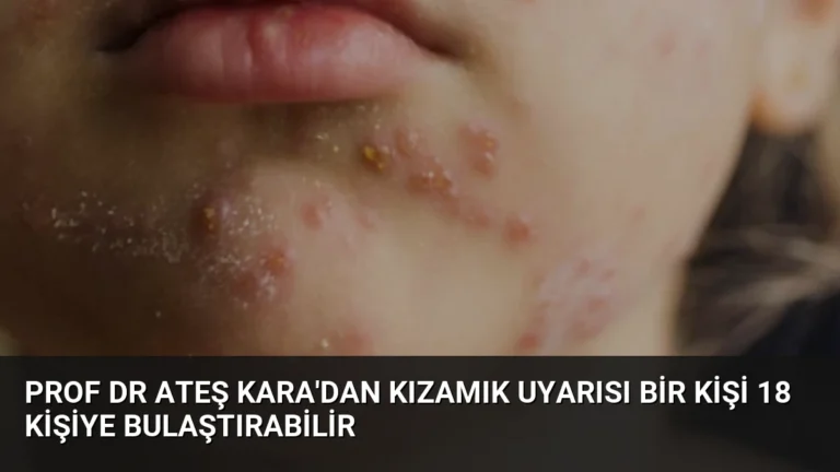 Prof Dr Ateş Kara’dan Kızamık Uyarısı Bir Kişi 18 Kişiye Bulaştırabilir